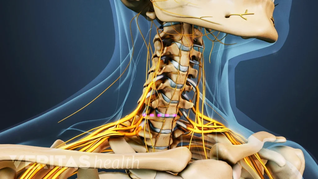 Cervical Spinal Stenosis