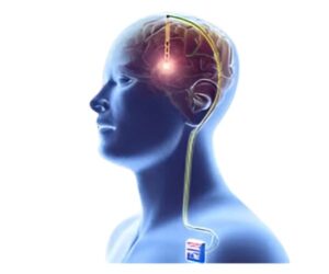 Deep Brain Stimulation surgery in nindia