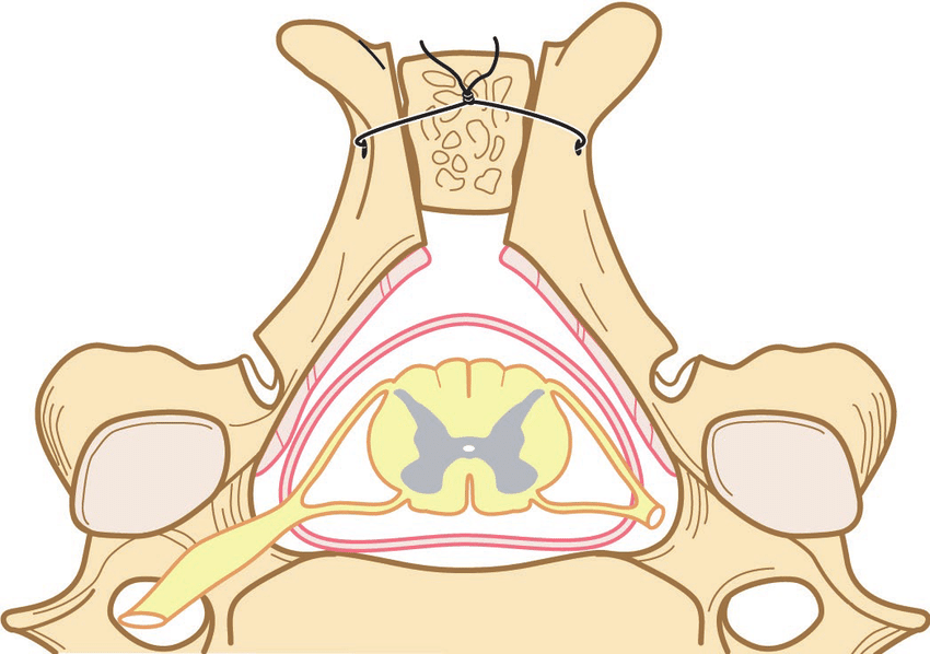 Open door laminoplasty
