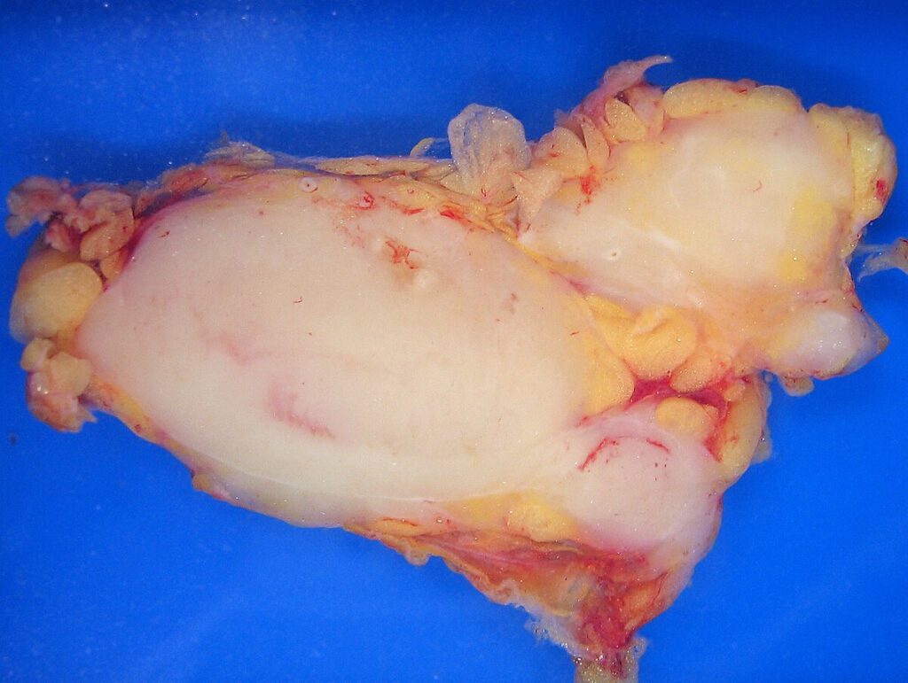 Lymphoma