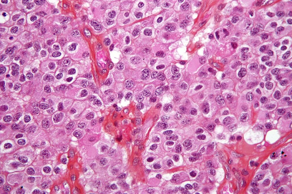 Oligodendrogliomas