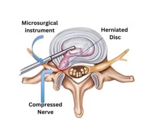 Micro Discectomy
