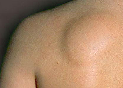 Sarcomas