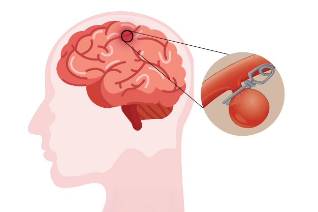 Brain Aneurysms