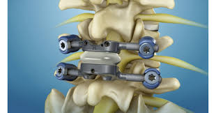 Facet Arthroplasty