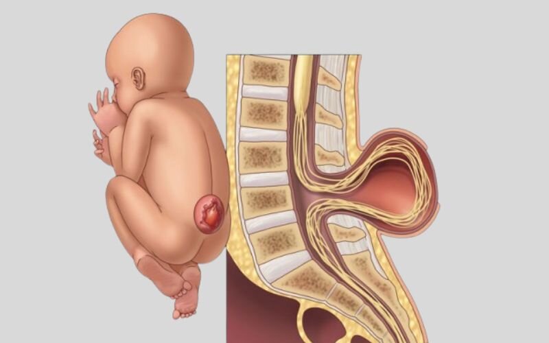 Spina Bifida