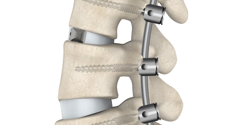 Lumbar Fusion