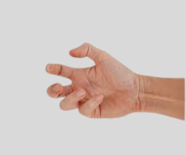 Dystonia Treatment