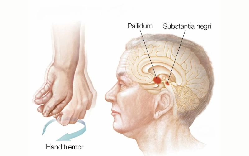 Parkinson" Disease