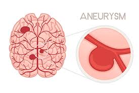 Brain Aneurysm