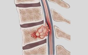 Spine Tumor